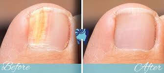 Foot Cure Nail Fungus Treatment