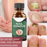 Foot Cure Nail Fungus Treatment