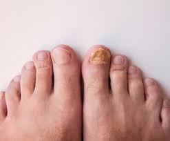Foot Cure Nail Fungus Treatment